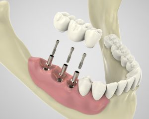 Implant dentaire&nbsp;: Quelles mutuelles vous rembourse le mieux&nbsp;?